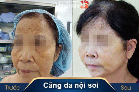 hình ảnh căng da mặt nội soi