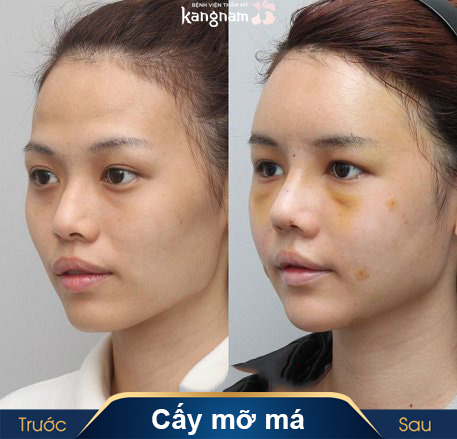 có ai cấy mỡ tự thân chưa