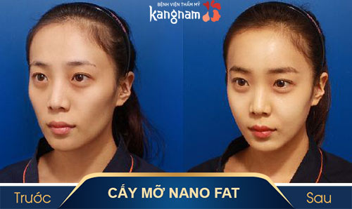 cấy mỡ tại thẩm mỹ Kangnam