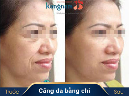 có nên phẫu thuật căng da bụng