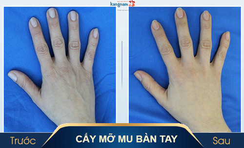 thẩm mỹ đôi bàn tay