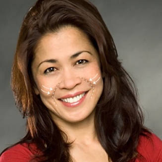 Làm đầy rãnh mũi má giúp thay đổi gương mặt bạn như thế nào?