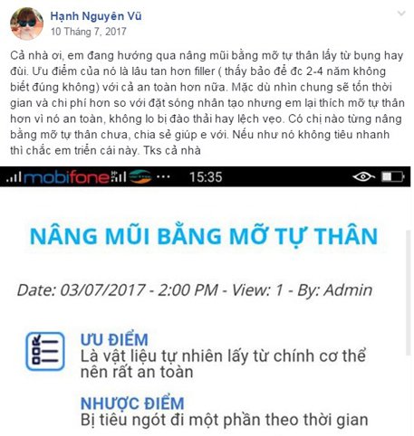 nâng mũi bằng mỡ tự thân kangnam