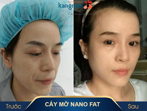 cấy mỡ nano