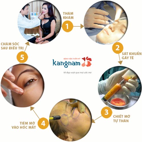 Cấy mỡ ở kangnam