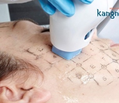 Công nghệ Trẻ hóa da Thermage KO cần phẫu thuật – Bảng giá 2019