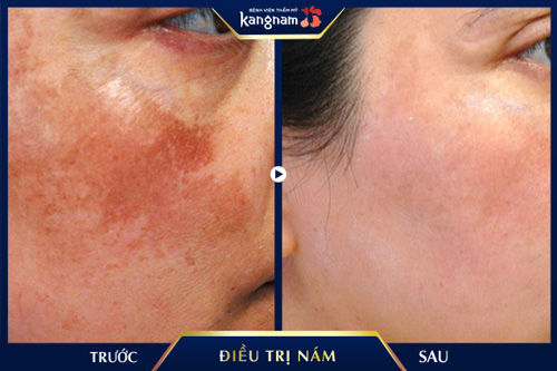 bắn laser trẻ hoá da