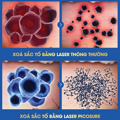 trẻ hóa da mặt bằng laser picosure