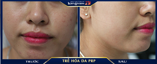 trẻ hóa da bằng prp