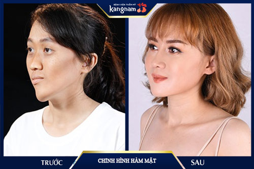 thẩm mỹ kangnam có tốt không