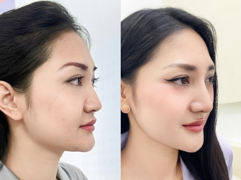 Khách hàng sở hữu dáng mũi dáng, rõ nét và tự nhiên